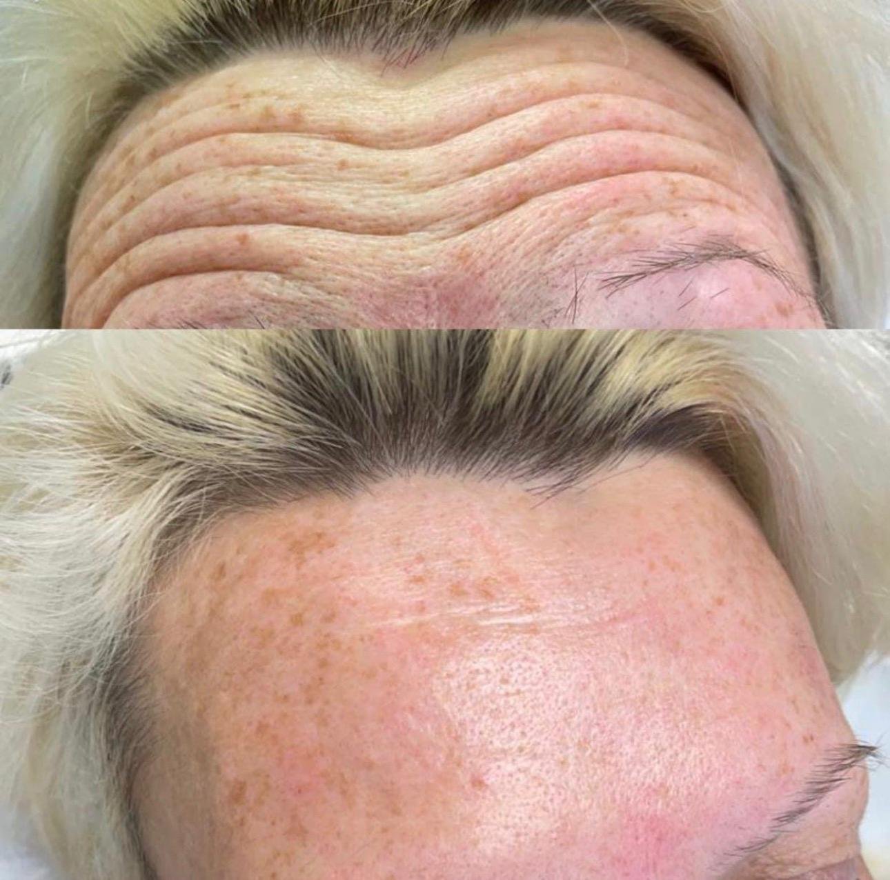 Anti - wrinkle