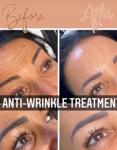 Anti - wrinkle